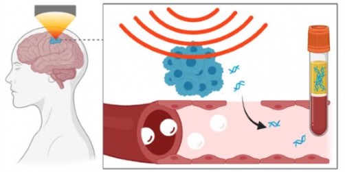 Image: Focused ultrasound can be used to temporarily open the blood-brain barrier (Photo courtesy of Washington University in St. Louis)